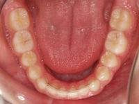 04-05--077-Lower Occlusal-14012016