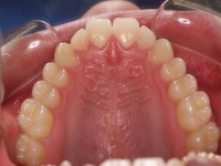 02-07-076-upper-occlusal-16032011