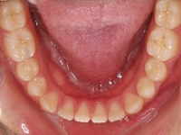 02-08-077-lower-occlusal-16032011