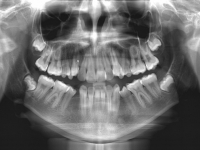 00-01-173-panoramic-xray-23032011