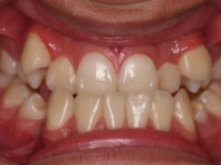 01-04-073-anterior-bite-23032011