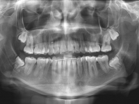 06-01-173-panoramic-xray-17092013