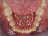 01-08-077-lower-occlusal-24022010