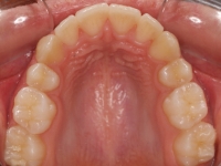 04-07-076-upper-occlusal-01012006