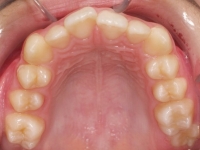 01-07--076-Upper Occlusal-01012006