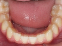 01-08--077-Lower Occlusal-01012006