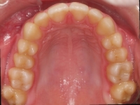 11-07--076-Upper Occlusal-01012006