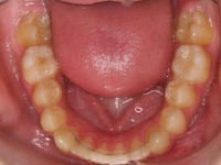 11-08--077-Lower Occlusal-01012006