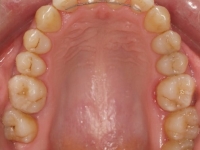 09-07--076-Upper Occlusal-20022018