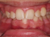 04-04-073-anterior-bite-07042011