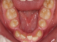 04-08-077-lower-occlusal-07042011