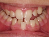 05-02-073-anterior-bite-07042011