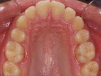 13-07-076-upper-occlusal-01012006