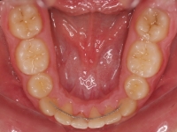 13-08-077-lower-occlusal-01012006