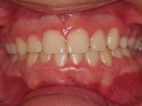 14-02-073-anterior-bite-01012006