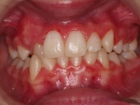 06-04--073-Anterior Bite-01012006.jpg