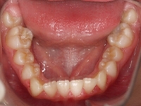 06-08--077-Lower Occlusal-01012006.jpg