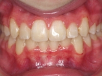 13-04--073-Anterior Bite-01012006.jpg