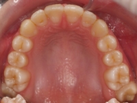 13-07--076-Upper Occlusal-01012006.jpg