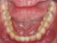 13-08--077-Lower Occlusal-01012006.jpg