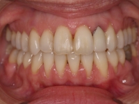 09-02-073-anterior-bite-01012006