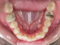 01-08-077-lower-occlusal-12052010-1024x789