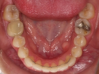 04-08-077-lower-occlusal-01012006