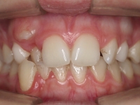 01-04-073-anterior-bite-19012011