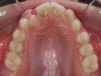 01-07-076-upper-occlusal-19012011