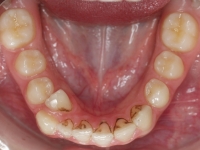 01-08-077-lower-occlusal-19012011