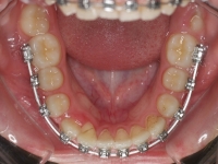 04-05-077-lower-occlusal-18082011