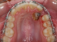 06-04-076-upper-occlusal-01012006