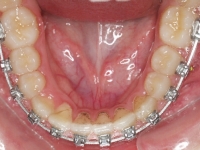 06-05-077-lower-occlusal-01012006