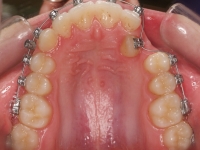 07-04-076-upper-occlusal-01012006