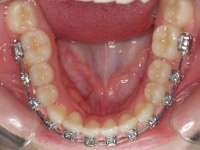 07-05-077-lower-occlusal-01012006