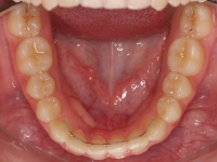 11-08-077-lower-occlusal-01012006