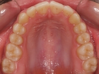 11-07-076-upper-occlusal-01012006