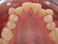 01-07-076-upper-occlusal-23032011