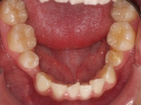 01-08-077-lower-occlusal-23032011