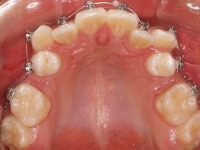 02-04-076-upper-occlusal-28062011