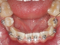 02-05-077-lower-occlusal-28062011