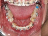 03-05-077-lower-occlusal-01012006