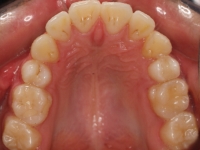 07-07-076-upper-occlusal-01012006