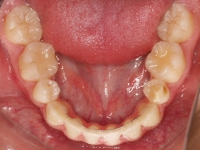 07-08-077-lower-occlusal-01012006